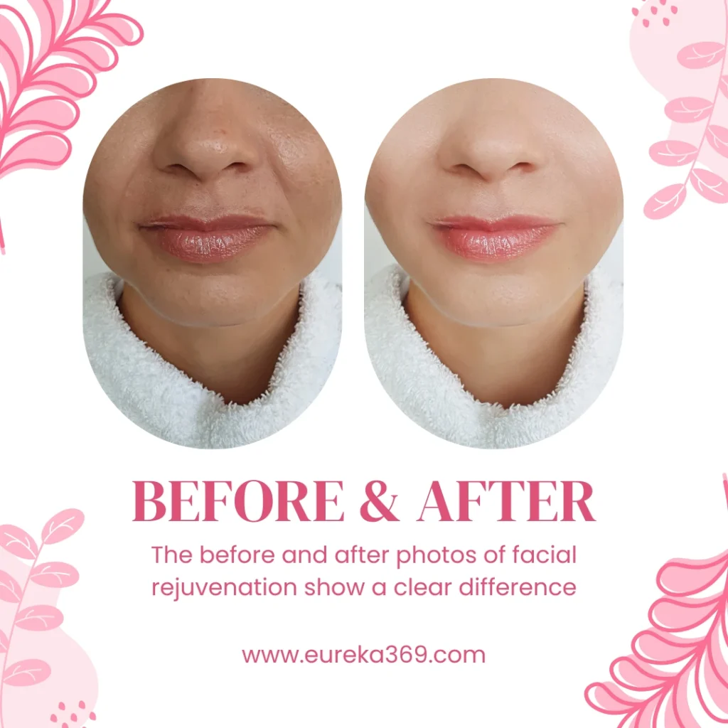 Non-Surgical Facial Rejuvenation before and after effect